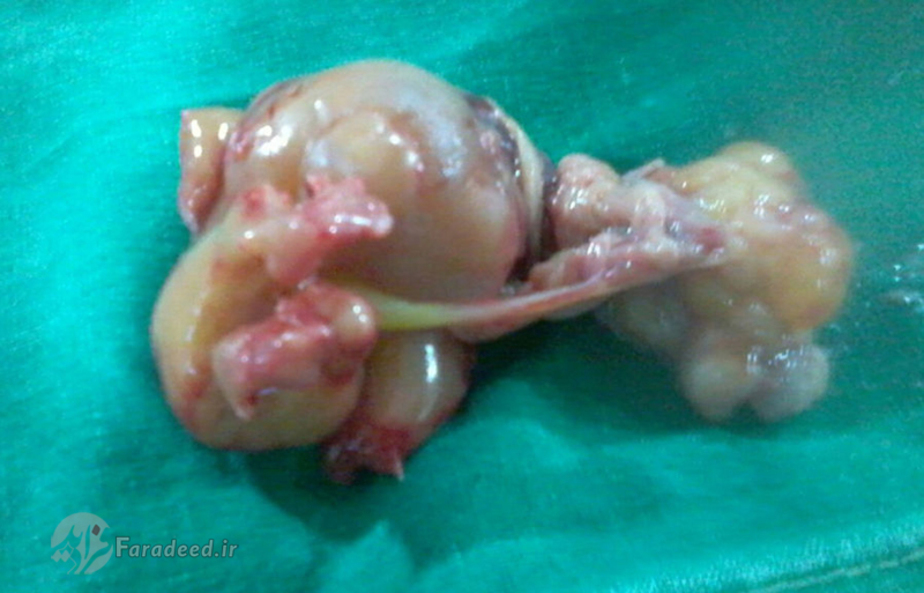 توده خارج شده از شکم نوزاد