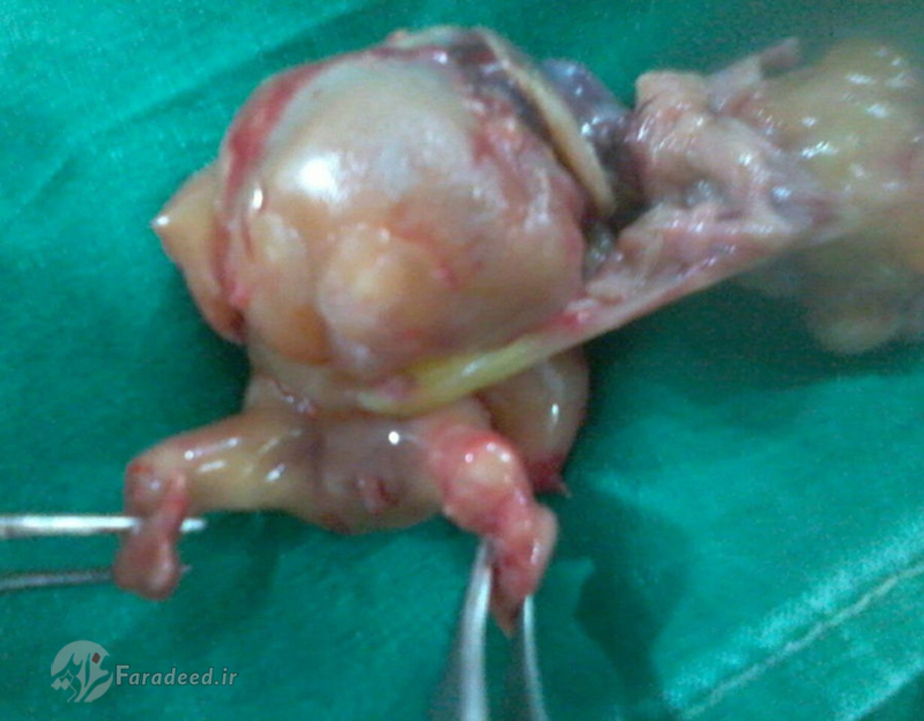 توده خارج شده از شکم نوزاد